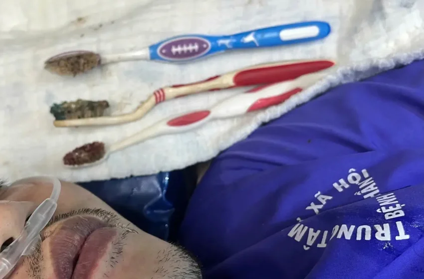  Bác sĩ gắp 3 bàn chải đánh răng từ đường tiêu hóa bệnh nhân